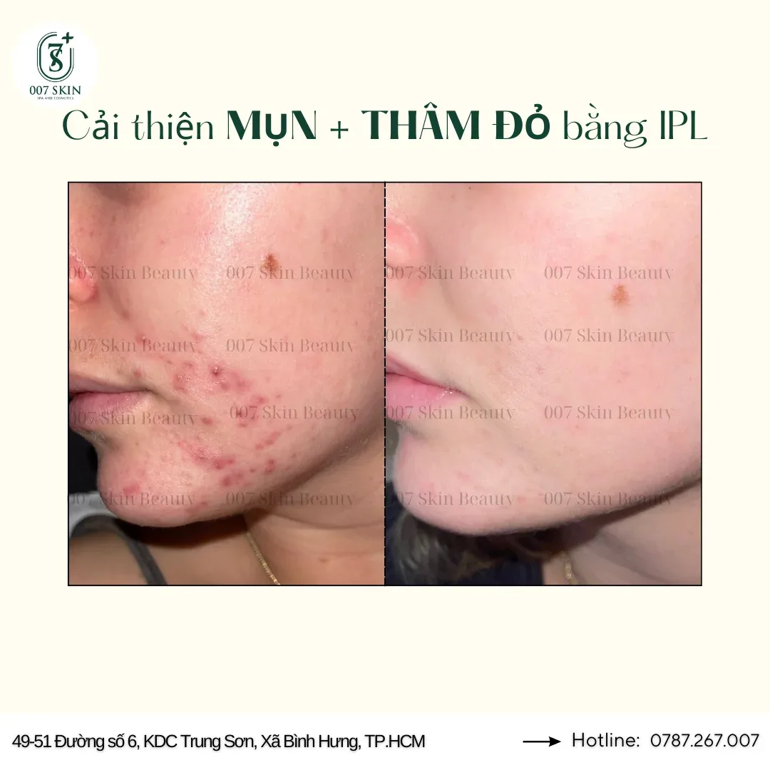 Ánh Sáng IPL: Bí Mật Da Sạch Mụn Cho 007 Dành Cho Da Dầu