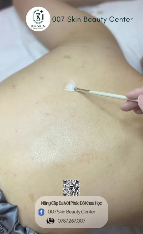 BACK CHEMICAL PEEL