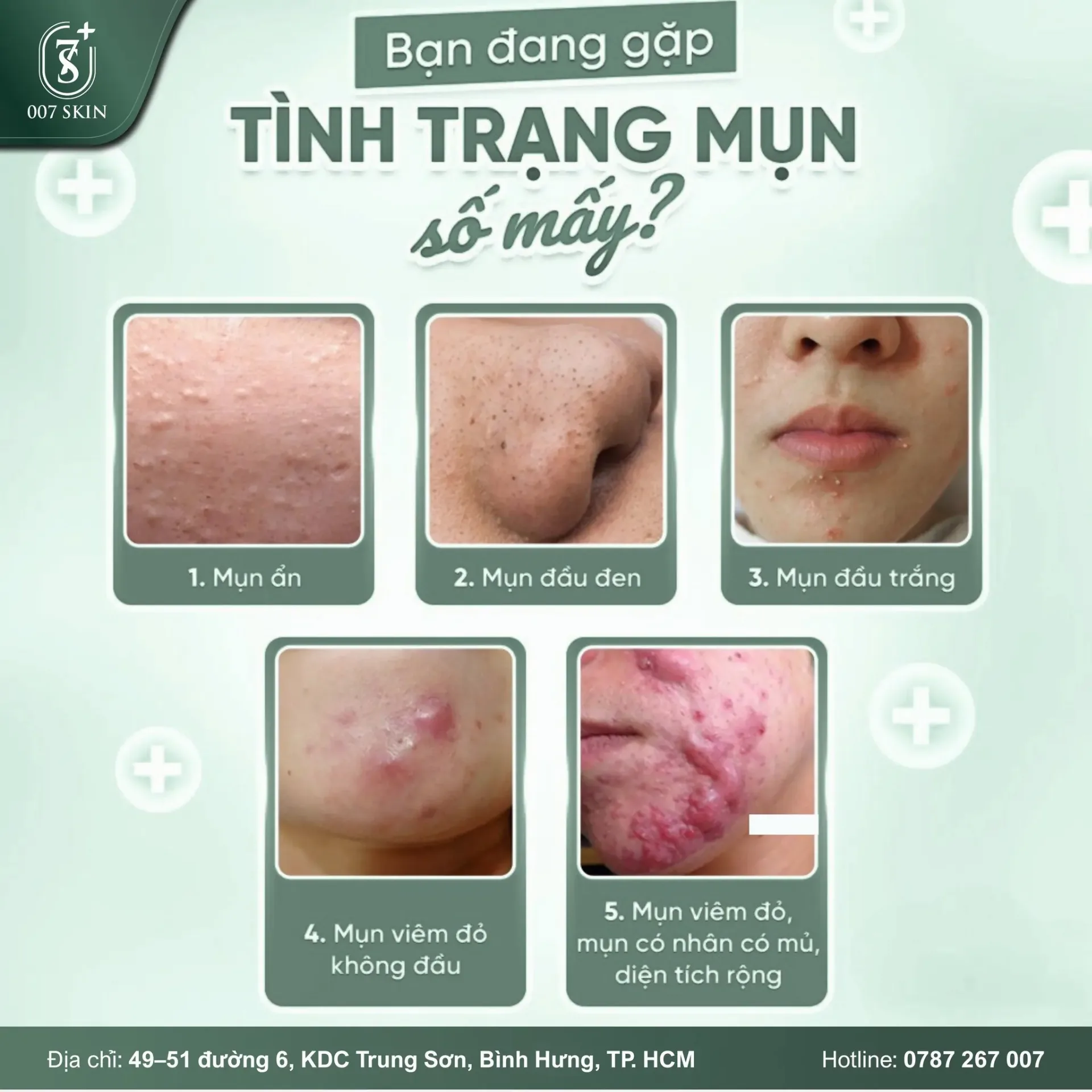BẠN ĐANG GẶP TÌNH TRẠNG MỤN SỐ MẤY? 💥