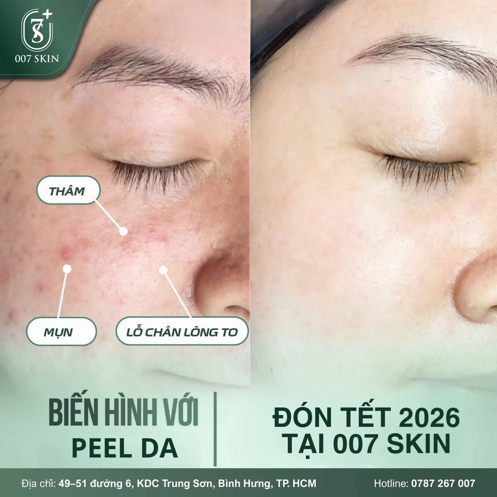 BIẾN HÌNH LÀN DA – TỰ TIN ĐÓN TẾT 2026 CÙNG 007 SKIN