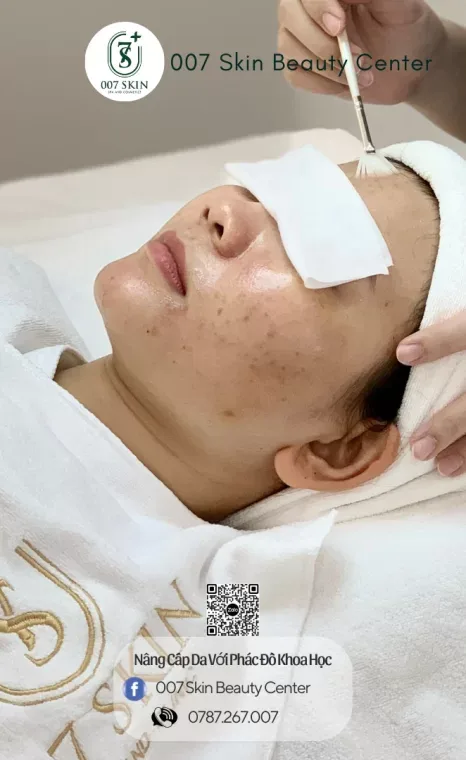 BRIGHTENING PEEL - PEEL TRẮNG SÁNG MỜ THÂM