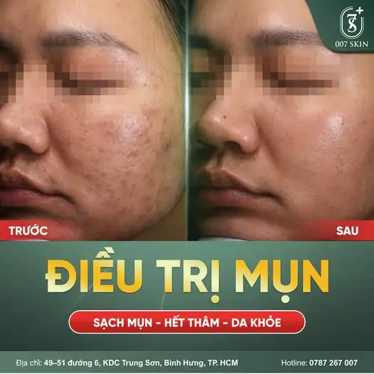 CA DA MỤN NẶNG – KIÊN TRÌ ĐÚNG CÁCH, DA SẼ KHÁC