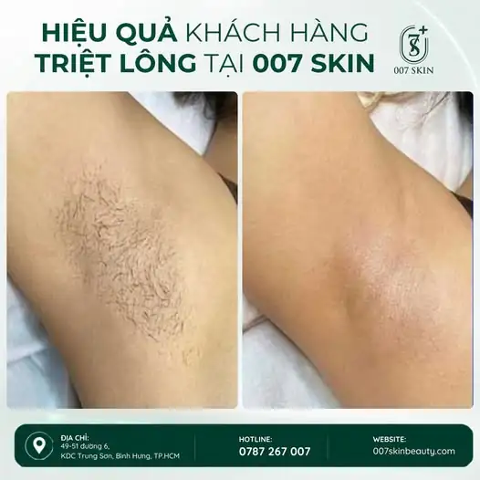 CẠO – NHỔ – WAX LIÊN TỤC, BẠN CÓ THẤY MỆT?