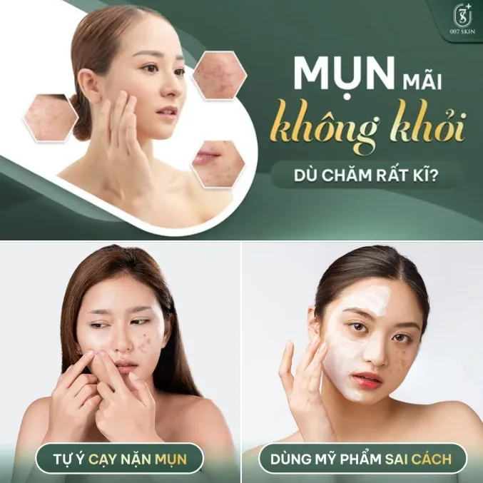 CHĂM DA "KỸ" NHƯNG MỤN VẪN HOÀI MỤN?