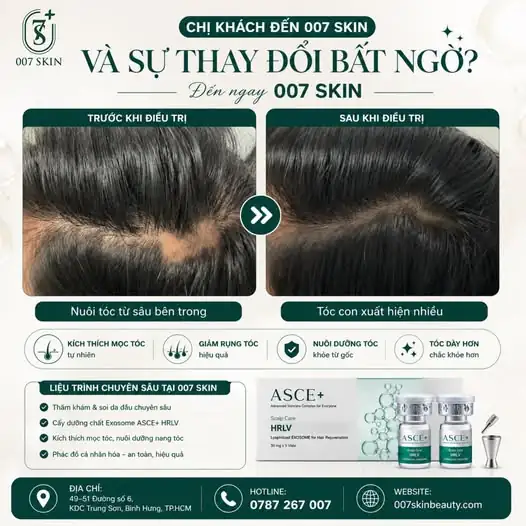 CHIÊM NGƯỠNG SỰ THAY ĐỔI BẤT NGỜ CỦA KHÁCH HÀNG TẠI 007 SKIN!