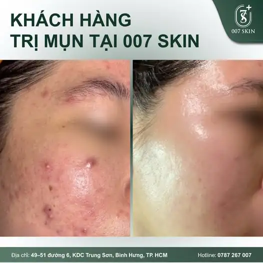 CHIẾN THẮNG MỤN NẶNG – HÀNH TRÌNH TÁI SINH LÀN DA MỚI 🛡️