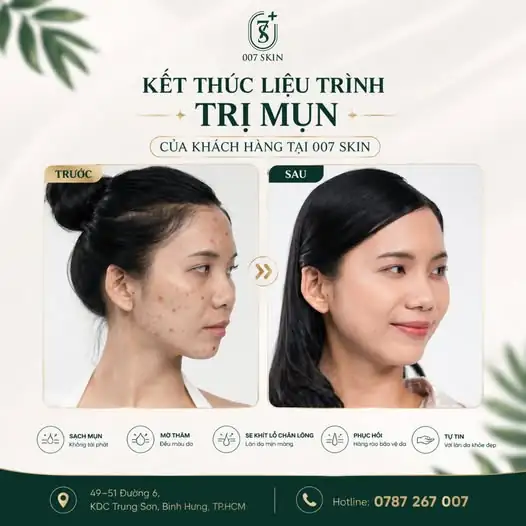 Chúng ta vừa kết thúc liệu trình trị mụn tuyệt vời của vị khách hàng tại 007 SKIN! Các bạn có thấy điều kỳ diệu đã xảy ra không? 😎