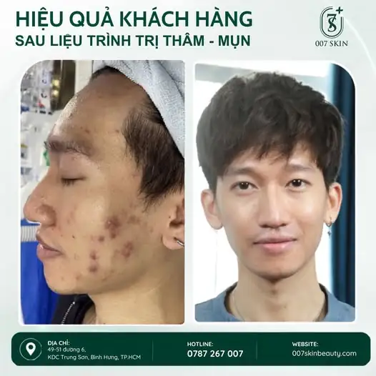 DA ĐẸP HƠN – TỰ TIN HƠN SAU LIỆU TRÌNH TRỊ THÂM MỤN ✨