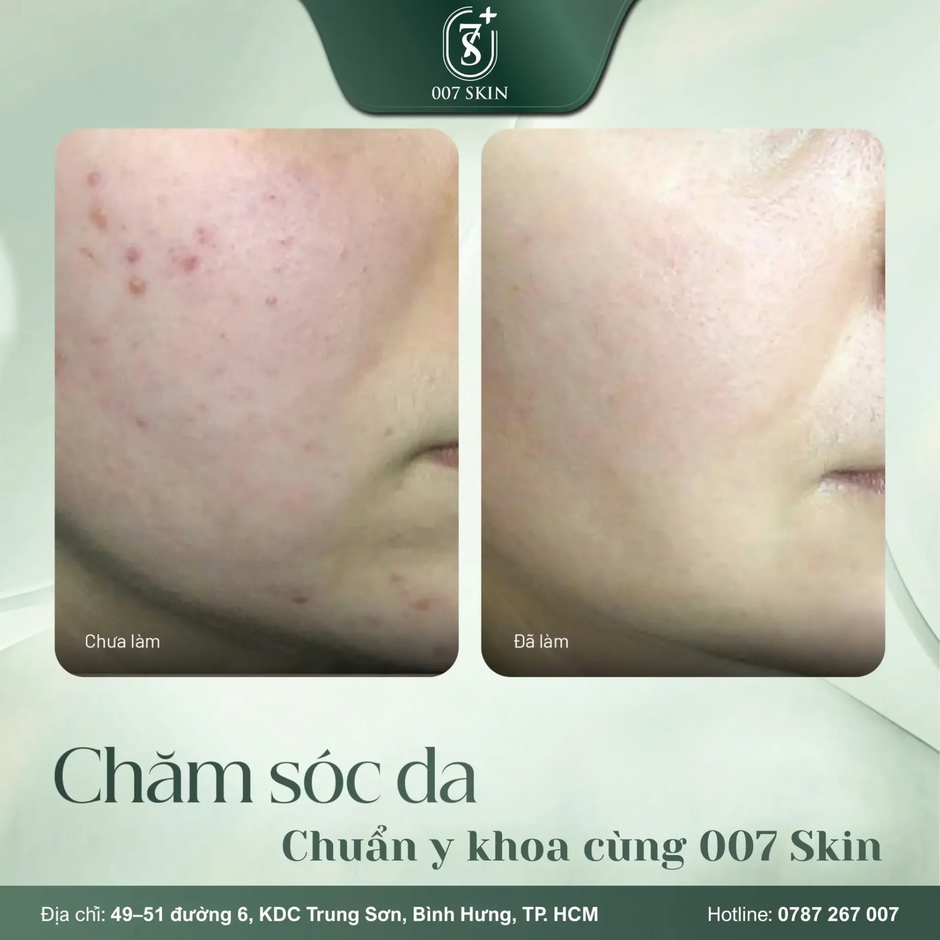 DA ĐẸP LÊN TỪNG NGÀY – NHỜ CHĂM SÓC CHUẨN Y KHOA TẠI 007 SKIN