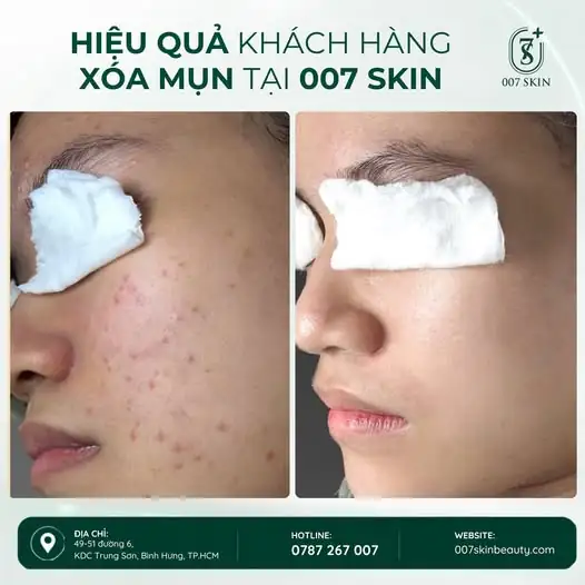 DA MỤN ĐỪNG CHỜ ĐẾN KHI MỤN NẶNG MỚI BẮT ĐẦU CHĂM SÓC!