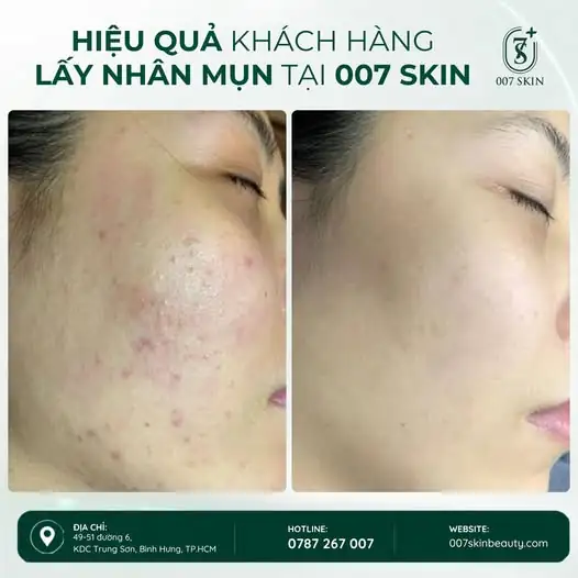 DA MỤN ĐỪNG CỐ “CHỊU ĐỰNG” – LẤY NHÂN MỤN ĐÚNG CÁCH