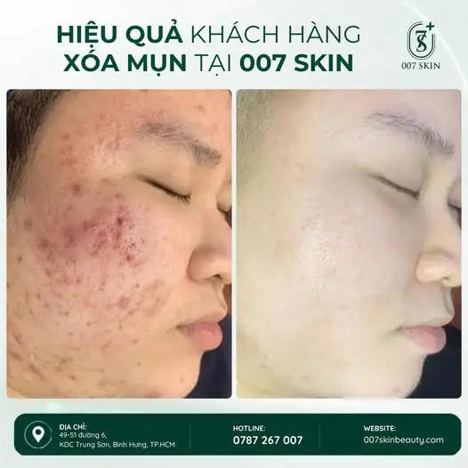 DA MỤN KHÔNG CÒN LÀ NỖI LO – TỰ TIN HƠN VỚI LÀN DA CỦA MÌNH!