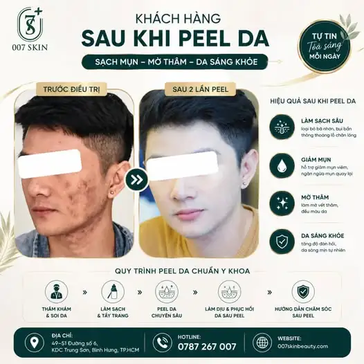 DA SẠCH MỤN, HẾT THÂM ĐEN - CHỈ SAU 2 LẦN PEEL! ✨