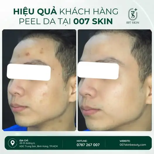 Da sần sùi, xỉn màu, nhiều mụn ẩn và thâm sau mụn khiến bạn thiếu tự tin?