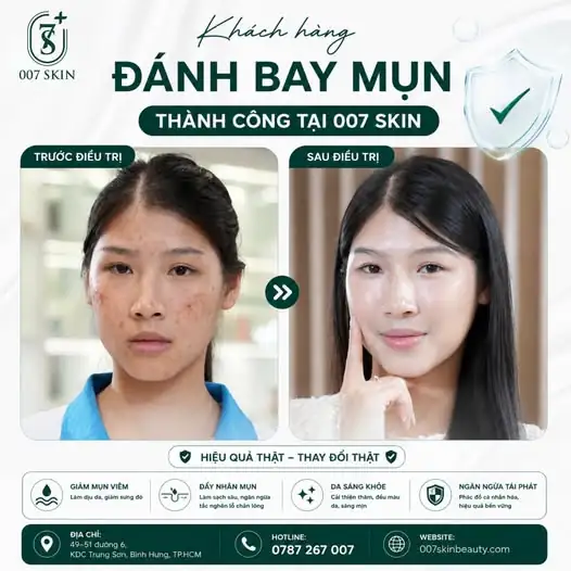 ĐÁNH BAY MỤN THÀNH CÔNG – LẤY LẠI TỰ TIN CÙNG 007 SKIN!