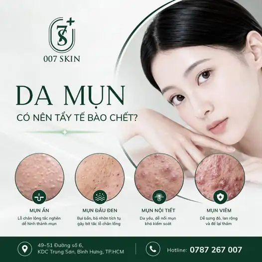 ĐAU ĐẦU VÌ MỤN? ĐỪNG BỎ QUA BƯỚC NÀY! ✨