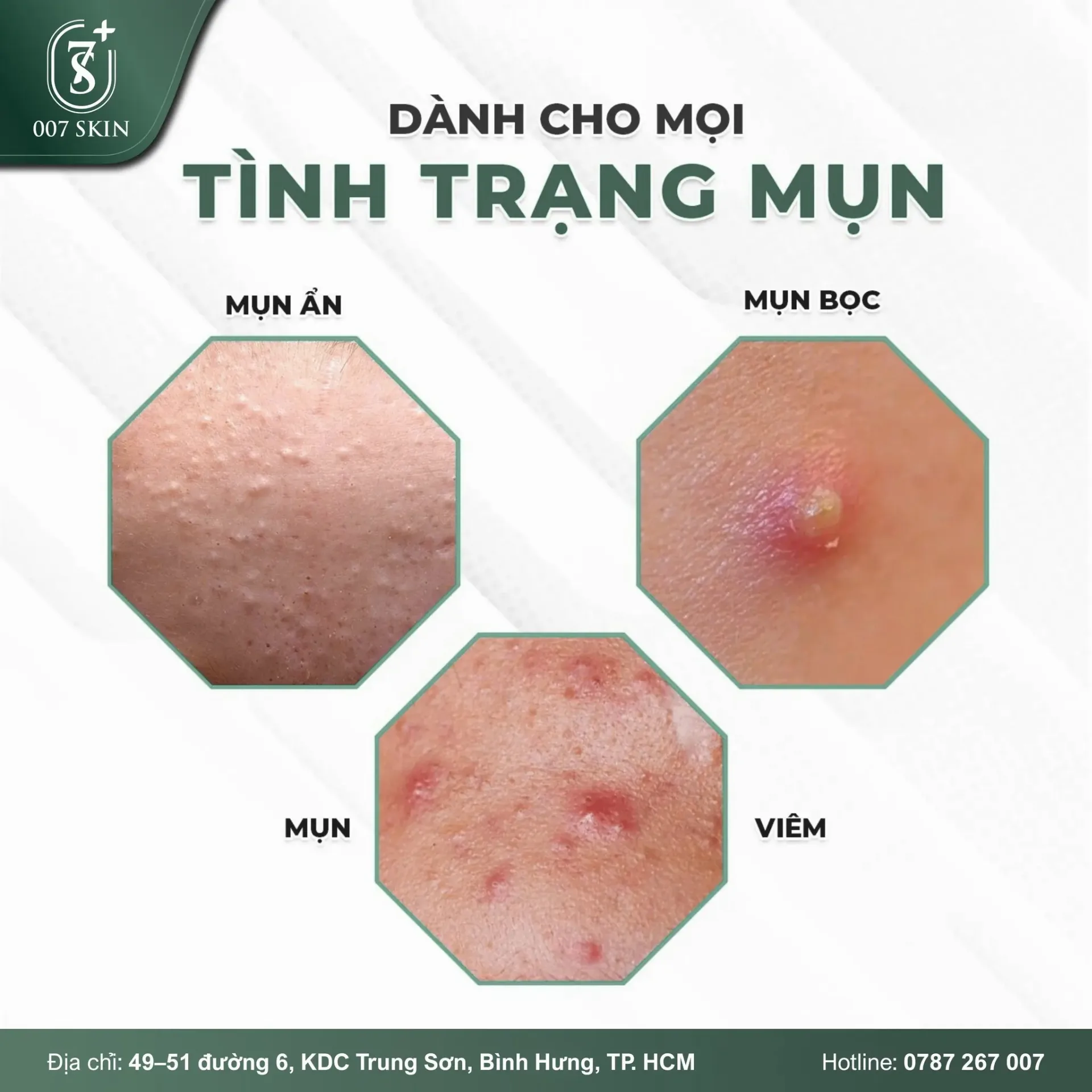 ĐIỀU TRỊ MỤN – PHÙ HỢP MỌI TÌNH TRẠNG DA