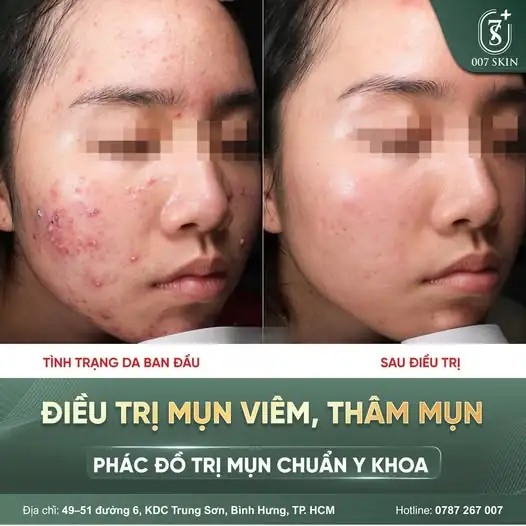 ĐIỀU TRỊ MỤN VIÊM – THÂM MỤN THEO PHÁC ĐỒ CHUẨN Y KHOA