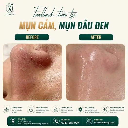 ĐỪNG ĐỂ MỤN ĐẦU ĐEN LÀM NỀN CHO CHIẾC MŨI KÉM DUYÊN! ❌