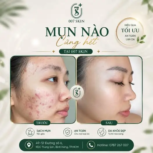 Đừng để mụn lấy đi sự tự tin của bạn!