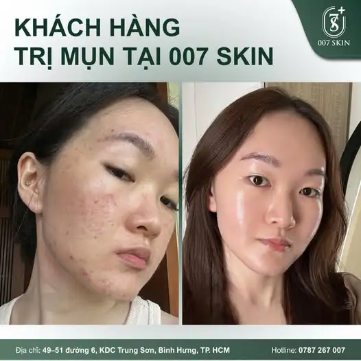 Đừng để những nốt mụn đáng ghét làm bạn mất tự tin khi xuống phố! Dù là mụn sưng viêm, mụn ẩn hay mụn đầu đen "lì lợm", 007 Skin Beauty Center đều có "vũ khí" đặc trị giúp bạn lấy lại làn da mịn màng tức thì. ⚡️