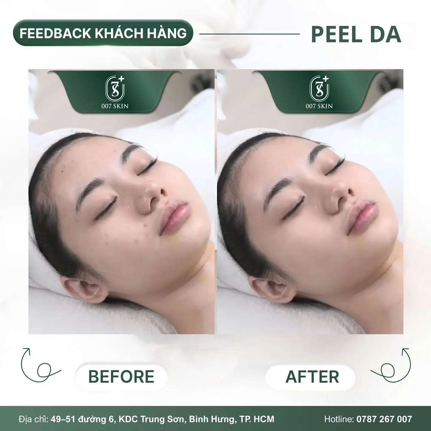 FEEDBACK THẬT – DA ĐẸP THẬT TẠI 007 SKIN BEAUTY CENTER