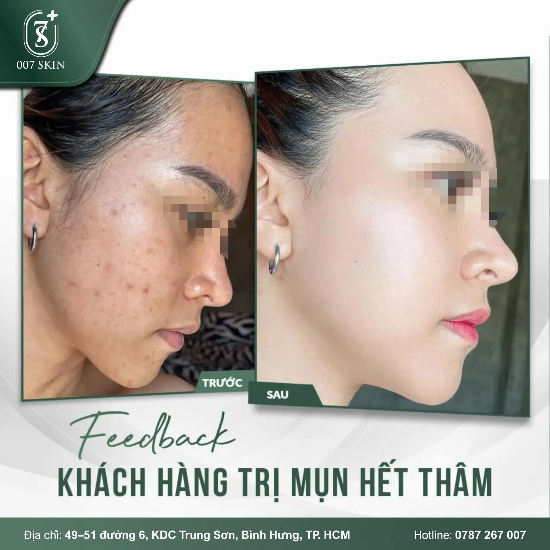 FEEDBACK THỰC TẾ – DA SẠCH MỤN, MỜ THÂM RÕ RỆT