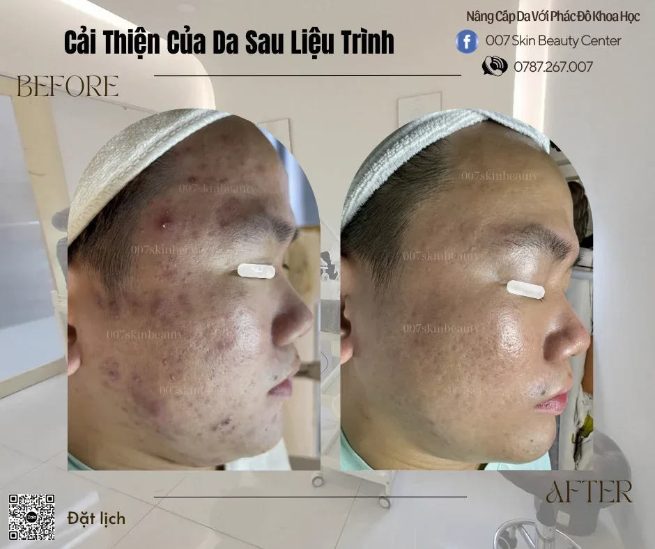 HÀNH TRÌNH LỘT XÁC CỦA LÀN DA – TỪ MỤN THÂM ĐẾN MỊN MÀNG SÁNG KHỎE