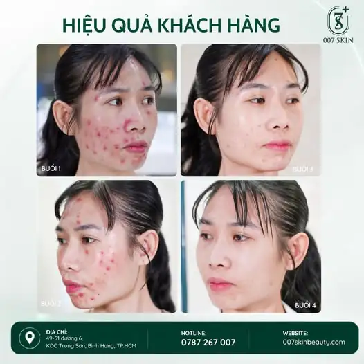 HIỆU QUẢ KHÁCH HÀNG – HÀNH TRÌNH THAY ĐỔI LÀN DA TẠI 007 SKIN ✨