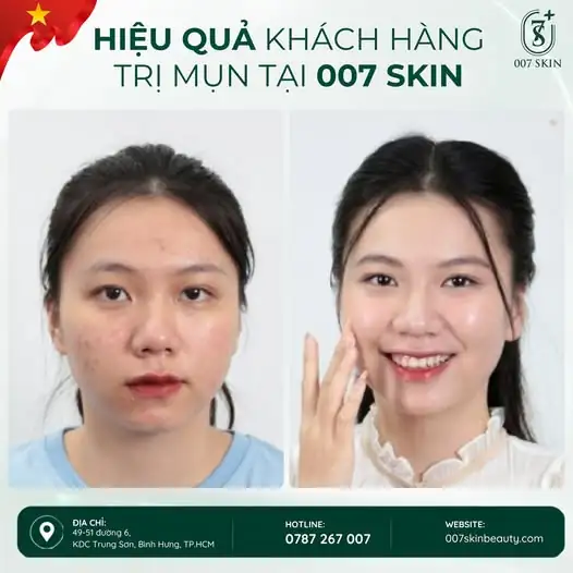 HIỆU QUẢ KHÁCH HÀNG TRỊ MỤN TẠI 007 SKIN ✨