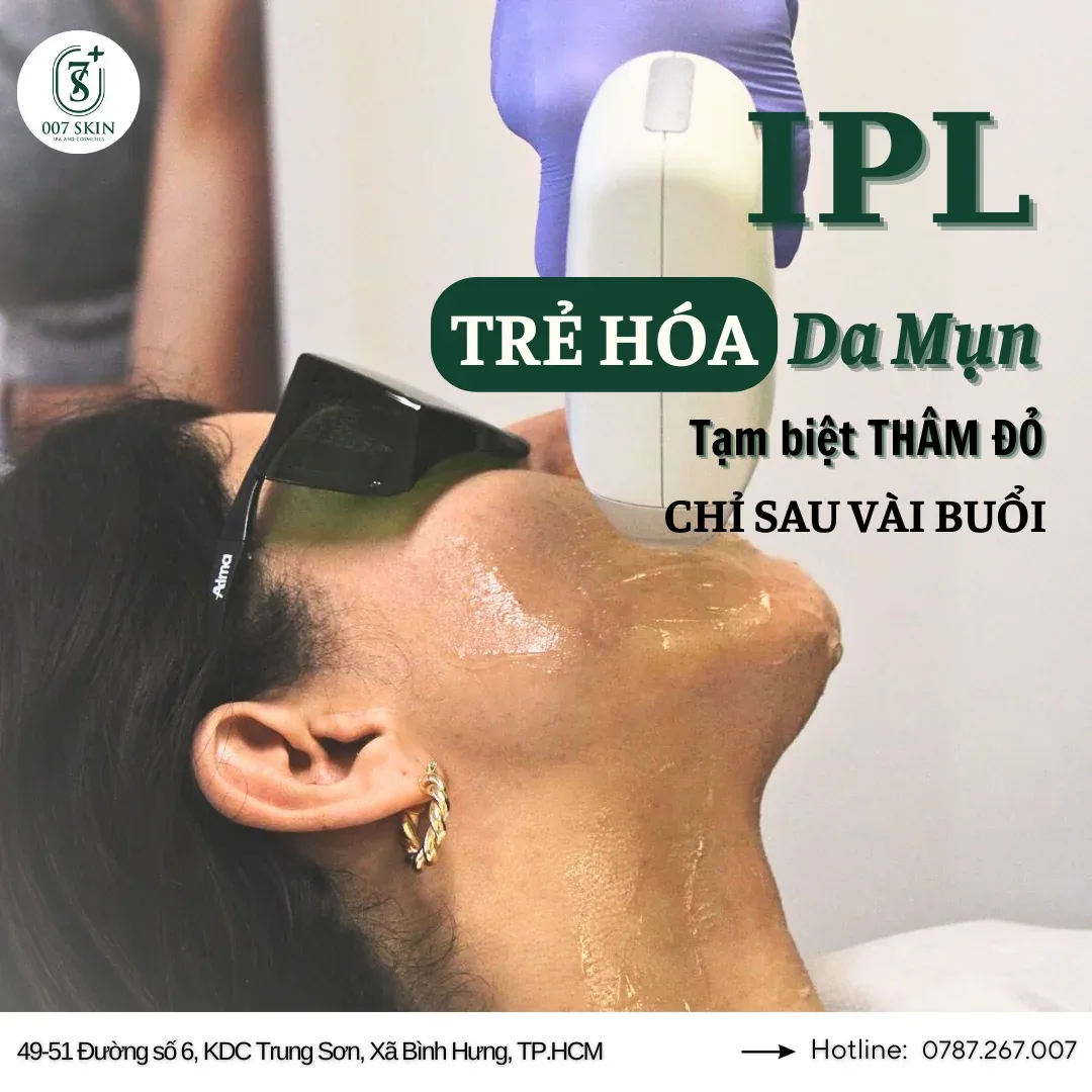 IPL: Giải Pháp Vàng Cho Làn Da Rạng Rỡ Với Công Nghệ Ánh Sáng Xung Cường Độ Cao