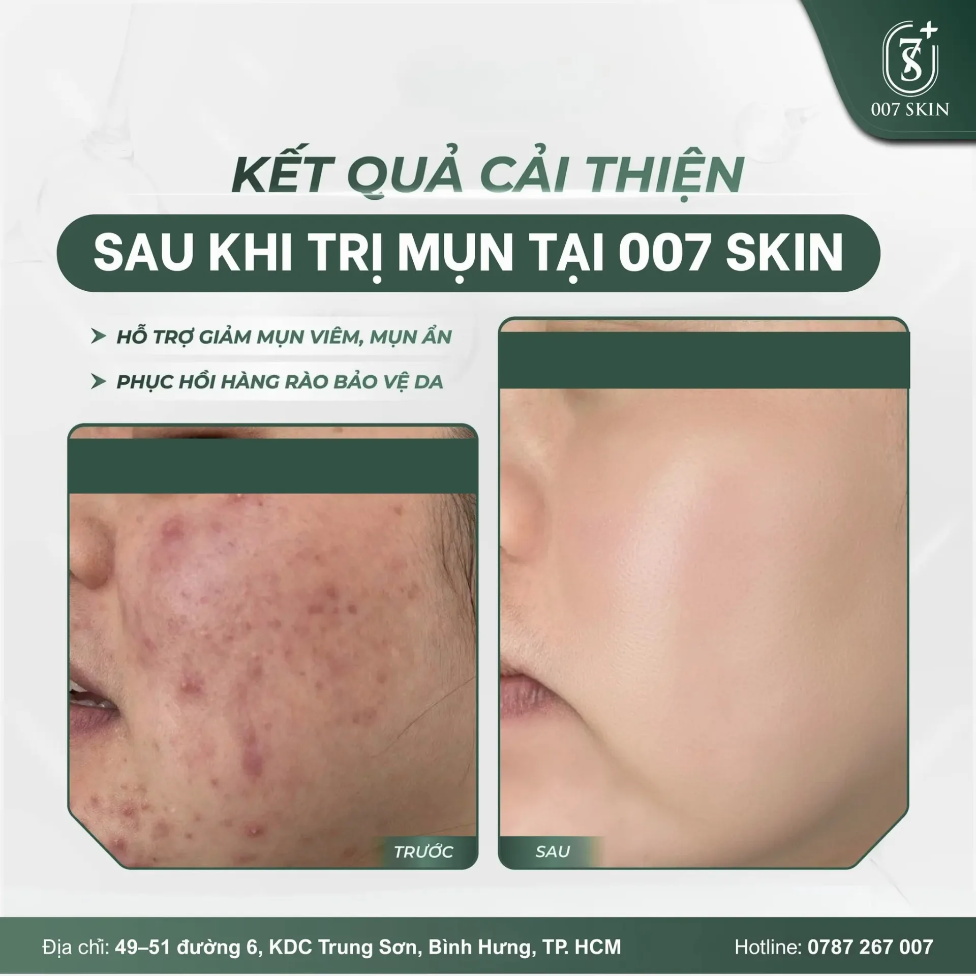 KẾT QUẢ CẢI THIỆN THỰC TẾ SAU KHI TRỊ MỤN TẠI 007 SKIN