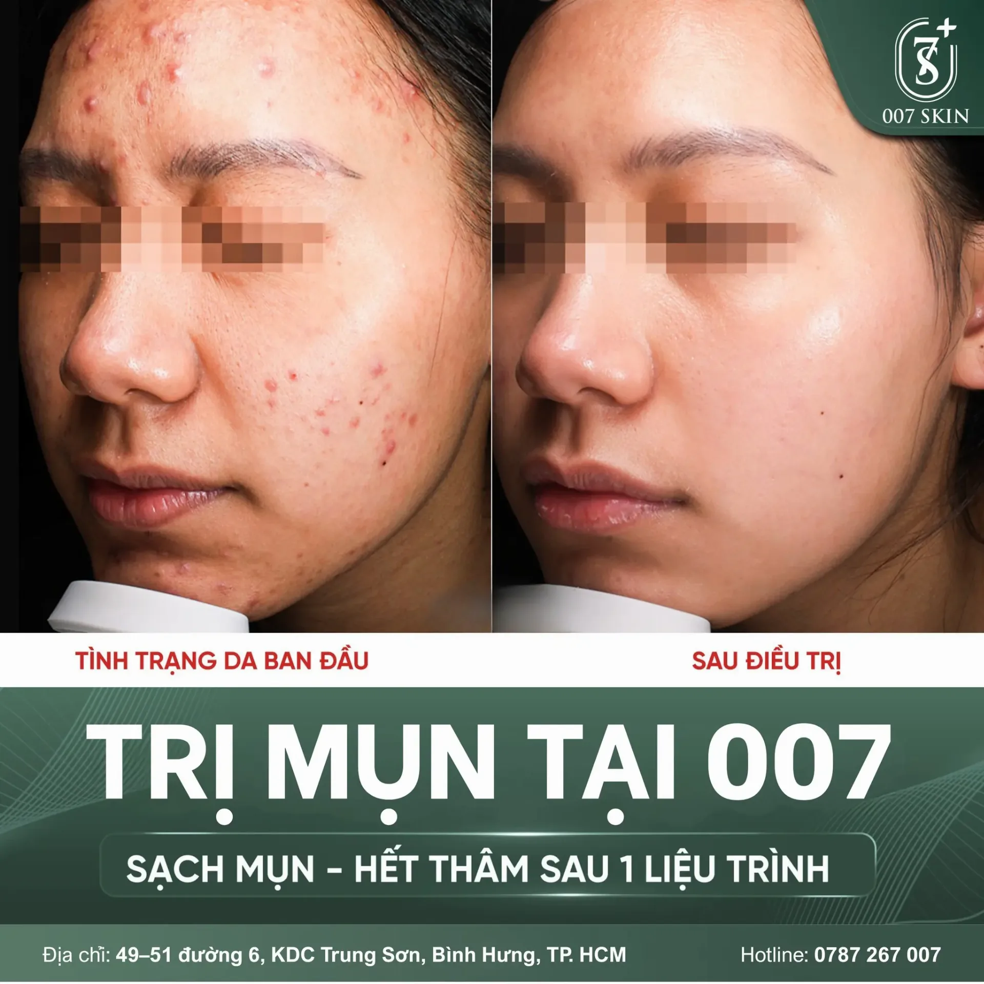 KẾT QUẢ SAU LIỆU TRÌNH CHĂM SÓC DA MỤN 📸