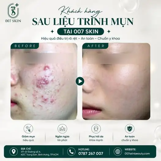 KẾT QUẢ THỰC TẾ - THAY ĐỔI RÕ RỆT CHỈ SAU LIỆU TRÌNH TẠI 007 SKIN