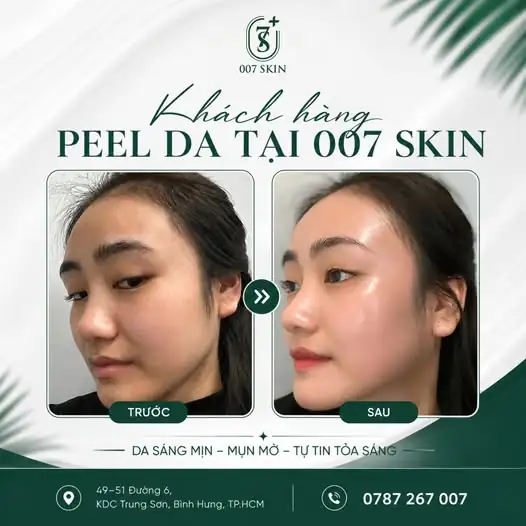 KHI LÀN DA LÊN TIẾNG: KẾT QUẢ THỰC TẾ SAU PEEL DA TẠI 007 SKIN ✨