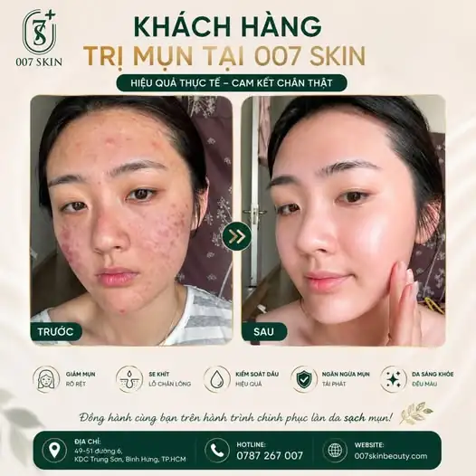 Không có làn da nào là "vô phương cứu chữa", chỉ có làn da chưa tìm đến 007 SKIN mà thôi! 😎