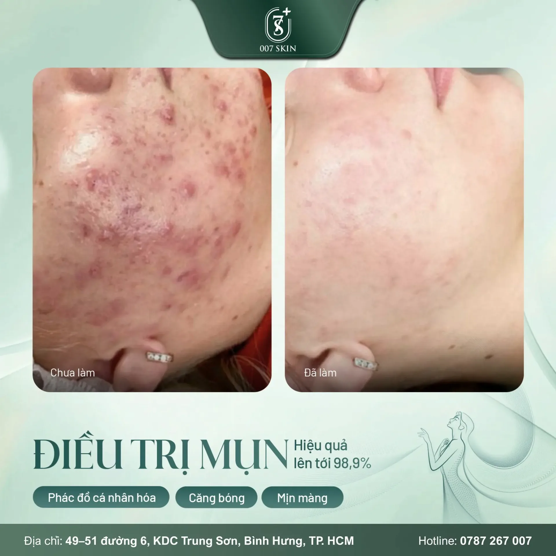 Không phải ai bị mụn cũng giống nhau — và vì thế mỗi làn da cần một phác đồ riêng biệt.