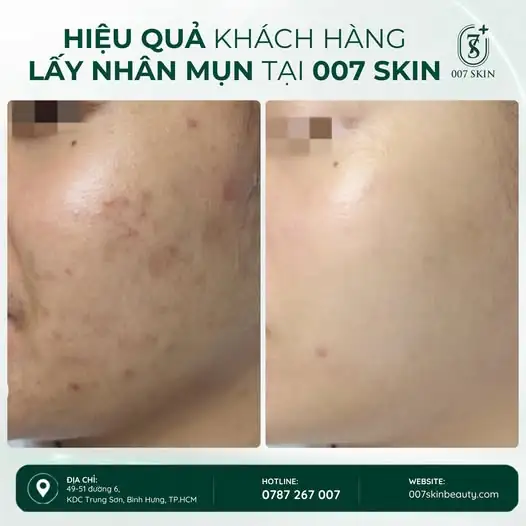 LẤY NHÂN MỤN – BƯỚC NHỎ, DA NHẸ NHÕM HƠN