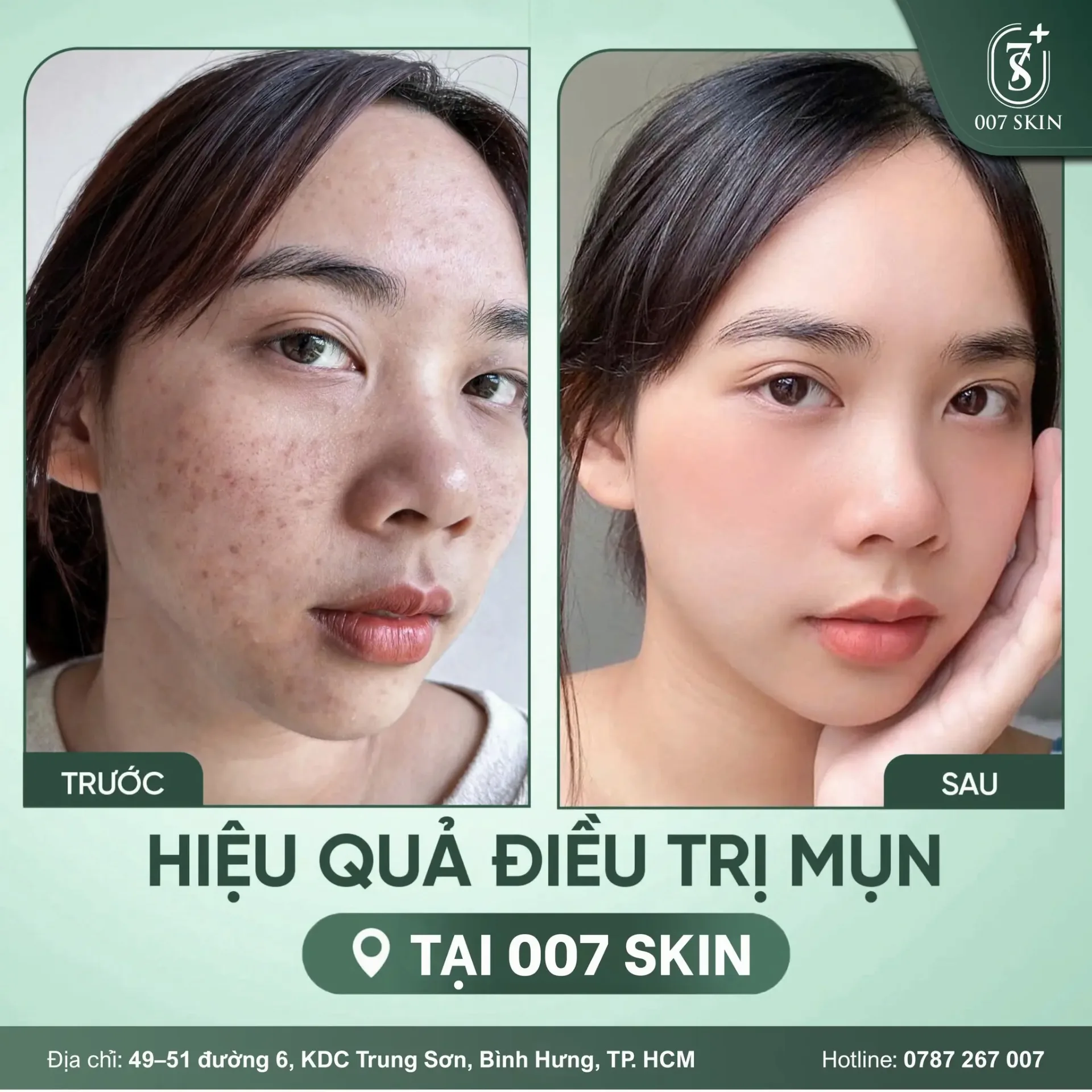 Lột Xác Làn Da: Hiệu Quả Điều Trị Mụn Rõ Rệt Tại 007 Skin