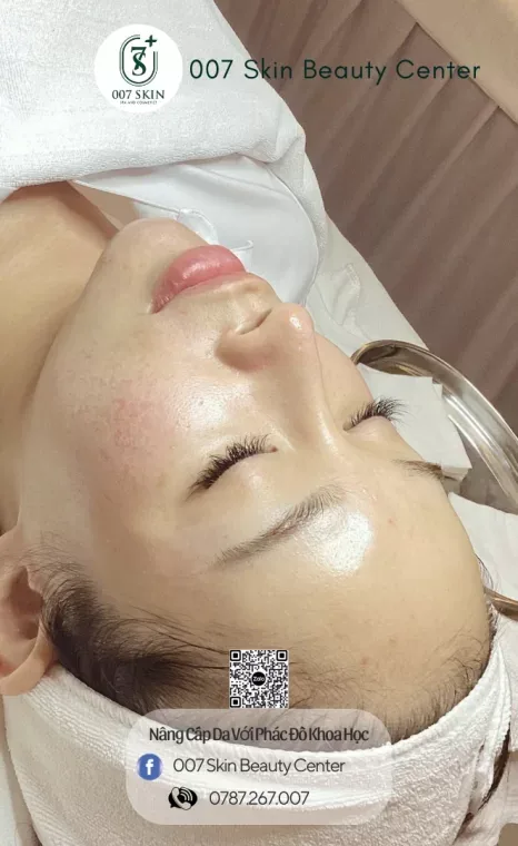 MESOTHERAPY EXOSOMES