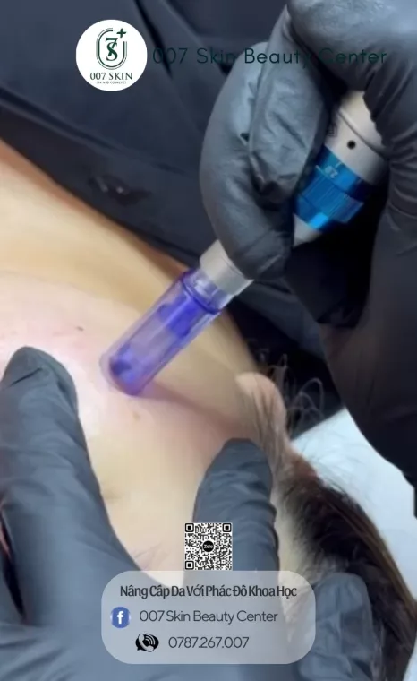 MICRONEEDLING PHI KIM TRỊ SẸO (KÈM THUỐC ĐẶC TRỊ MANG VỀ)