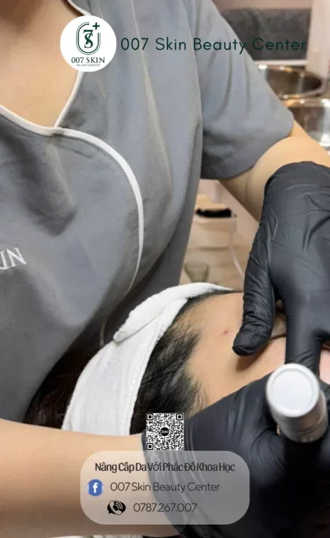 MICRONEEDLING PHI KIM TRỊ SẸO