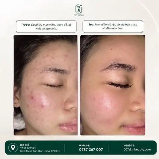 MỘT LÀN DA THAY ĐỔI – THÊM TỰ TIN MỖI NGÀY!