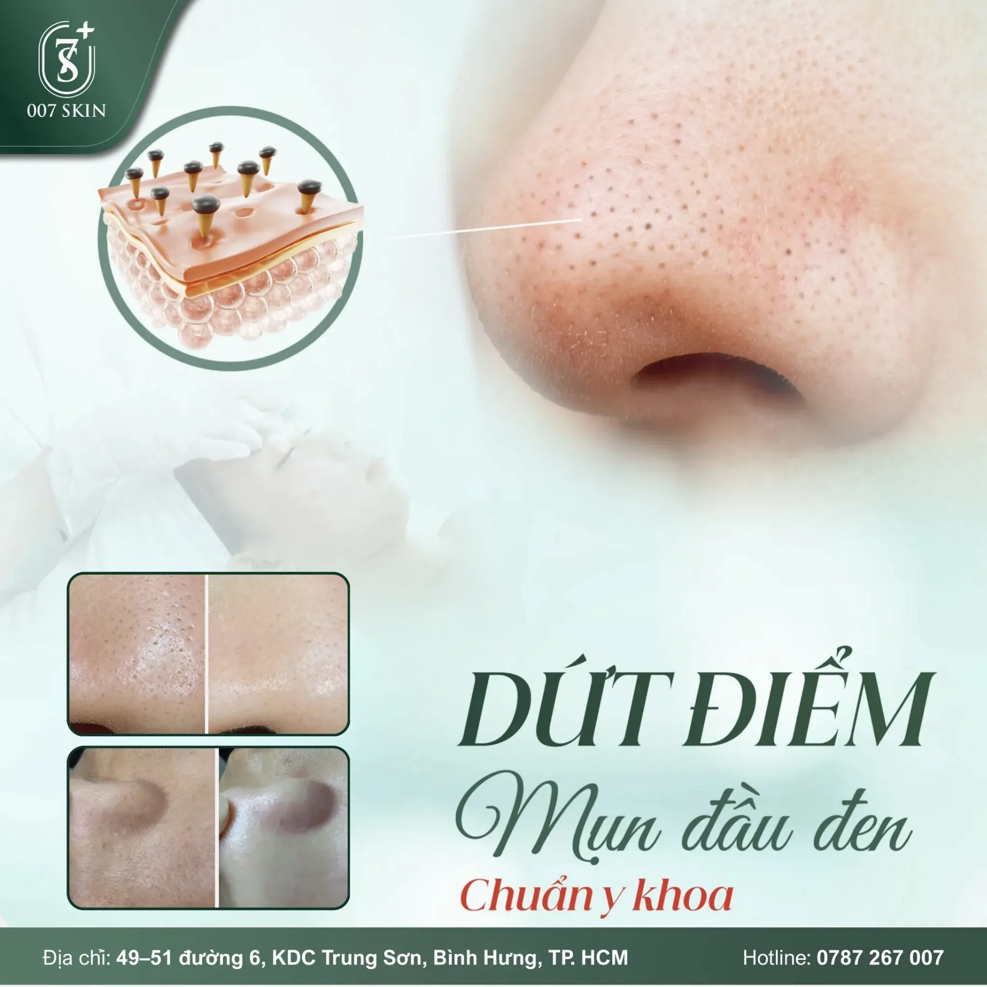 MỤN ĐẦU ĐEN – ĐỪNG ĐỂ “Ở LẠI” TRÊN LÀN DA BẠN!