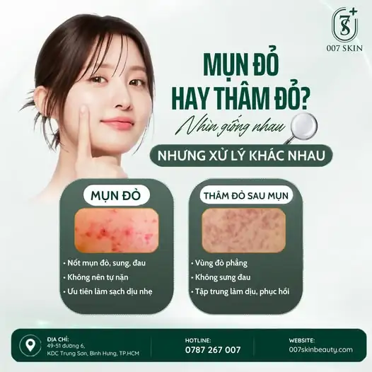 MỤN ĐỎ HAY THÂM ĐỎ SAU MỤN? ĐỪNG NHẦM LẪN!