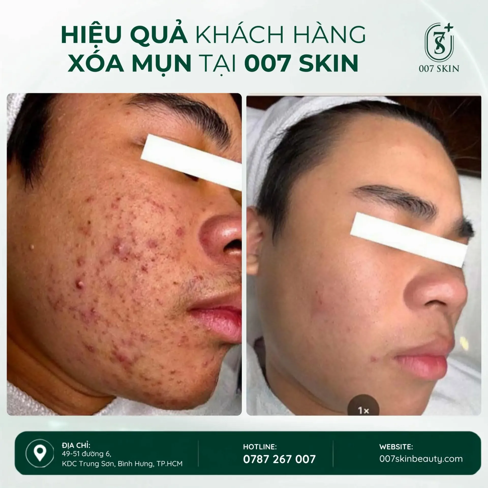 MỤN GIẢM – DA SẠCH HƠN – TỰ TIN HƠN MỖI NGÀY ✨