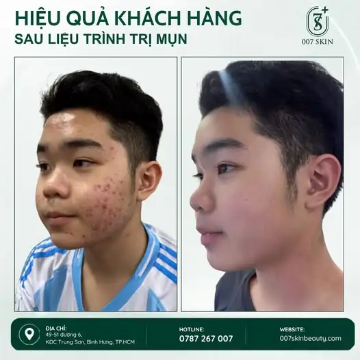 Mụn giảm – da sáng hơn ✨