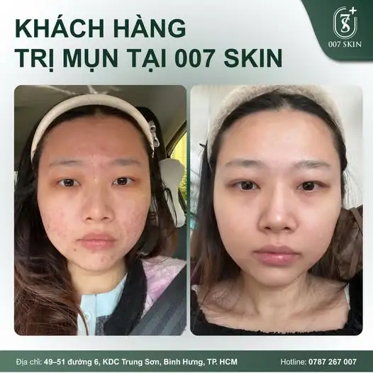 MỤN KHÔNG TỰ NHIÊN SINH RA, CŨNG KHÔNG TỰ NHIÊN MẤT ĐI... 🧬
