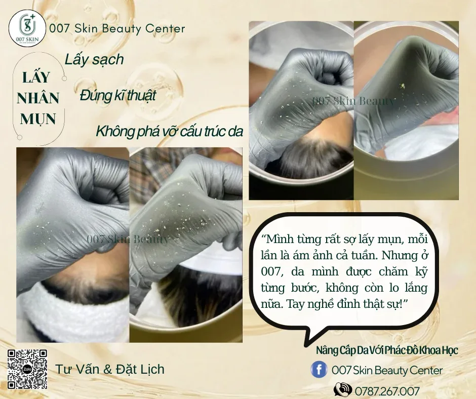 Mụn Viêm: Nguyên Nhân, Triệu Chứng và Cách Điều Trị Dứt Điểm