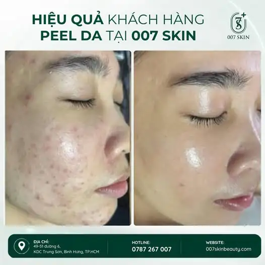 MUỐN DA CĂNG BÓNG – SÁNG MỊN? ĐỪNG BỎ QUA PEEL DA ￼
